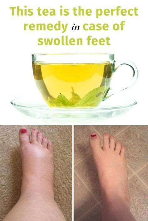 This Tea Is The Perfect Remedy In Case Of Swollen Feet Healthy Foods