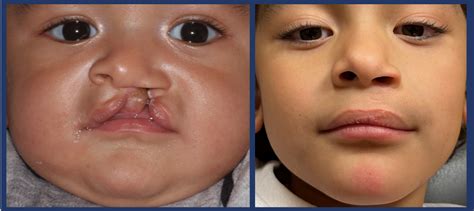 Cleft Palate Repair Before And After