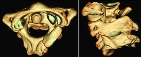 Three Dimensional Computed Tomography Reconstruction Showing A Defect
