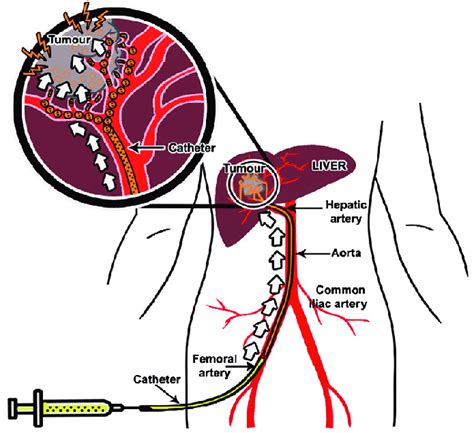 Principle Of Conventional Transarterial Chemoembolization Download