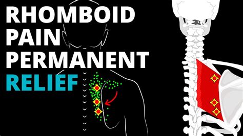 How To Fix Rhomboid Pain Permanently Corrective Exercises And Stretches