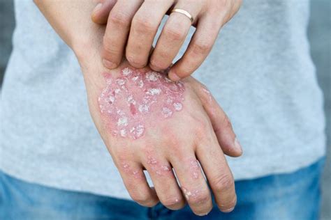 How To Get Rid Of Skin Fungus