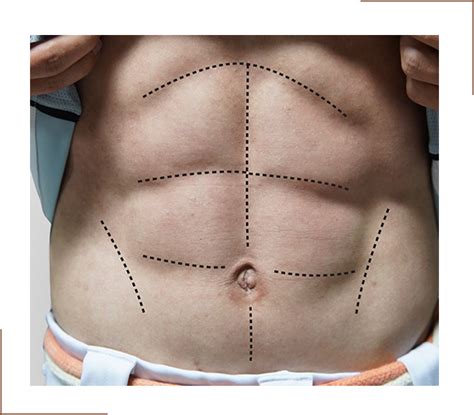 Six Pack Surgery For Men Abdominal Liposuction Men