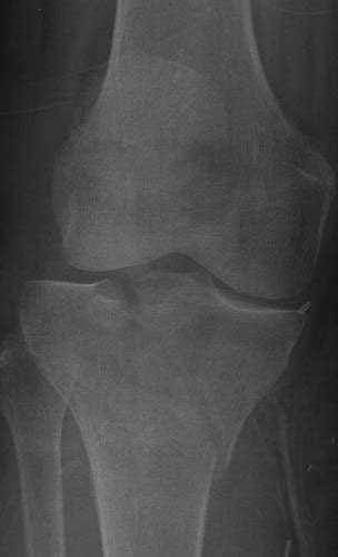 Schatzker Classification Of Tibial Plateau Fractures Use Of Ct And Mr