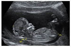 Between 11 weeks and 13 weeks plus six days of pregnancy or when your baby measures between 45mm and 84mm, crown to rump Nuchal Translucency Ultrasound - Prenatal Screening Ontario