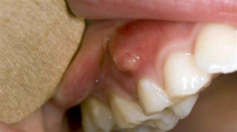 Hard Lump On Gum Below Tooth