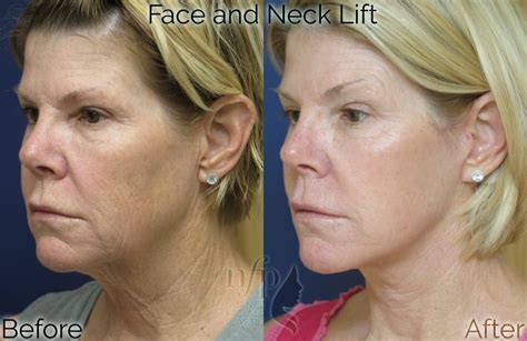 Facelift Dr Summit Kundaria Nuance Facial Plastics Charlotte Nc