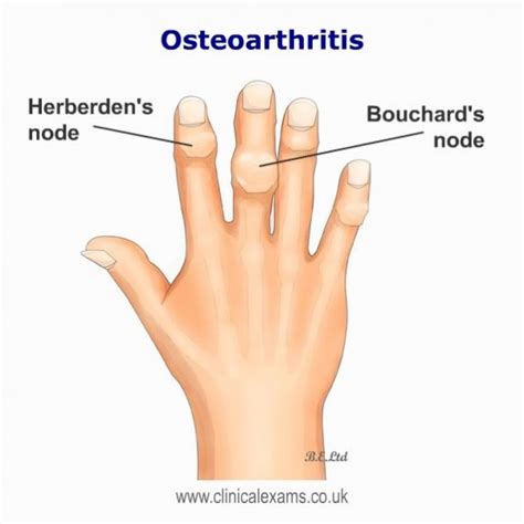 Heberden S Bouchard S Nodes Osteoarthritis