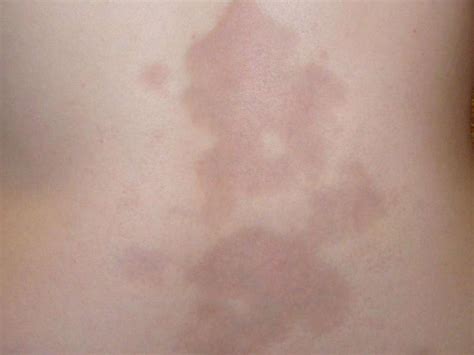 Morphea Symptoms Causes And Treatment