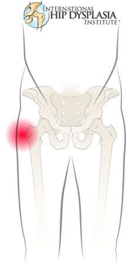 Pin On Hip Problems