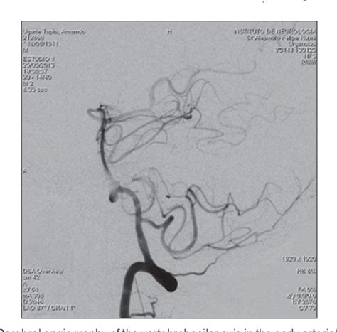Figure 1 From Unilateral Triplication Of Superior Cerebellar Artery