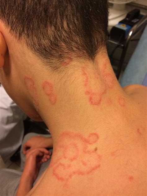 Atypical Extensive Tinea Corporis Caused By Trichophyton Tonsurans