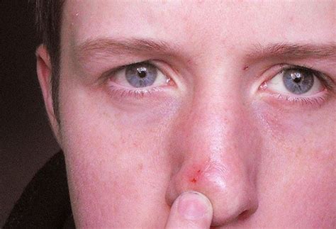 Blind Pimple On Nose Chin Get Rid Pop Causes Home Remedies To