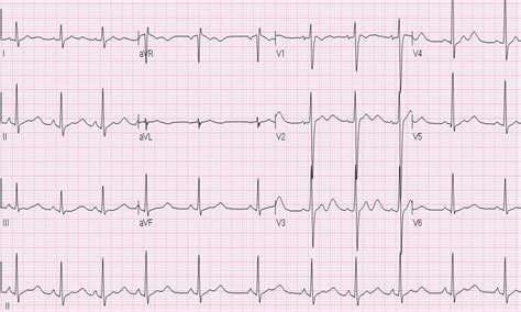 Hypokalemia Symptoms Causes Ecg And Treatment 2018