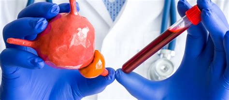 Sangue Na Urina Principais Causas E Como Tratar Urologista Em S O Carlos Dr Helder Polido