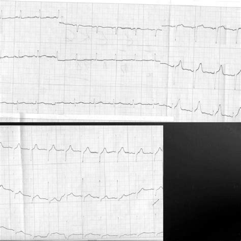 Ecg Before Radiation Therapy Shows Sinus Rhythm With Left Ventricle