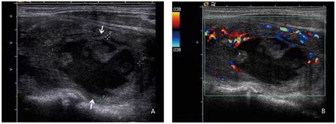 Sonographic differentiation of asymptomatic diffuse thyroid disease from normal thyroid: Role of ultrasound evaluation for the diagnosis and ...