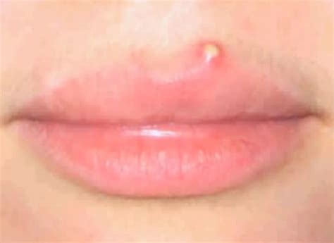 They're those pesky zits that can pop up right on the border of your lips (called the lip line). Pimple on lip line | HubPages