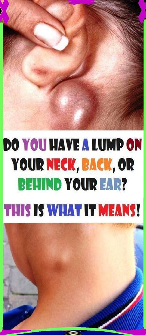 Uzalude23 In 2021 Lump Behind Ear Skin Bumps Swollen Lymph Nodes