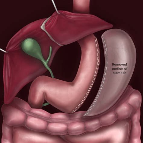 Sleeve Gastrectomy Ohio State Bariatric Surgery