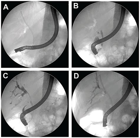 Non Operative Management Of Bronchobiliary Fistula Due To Proximal