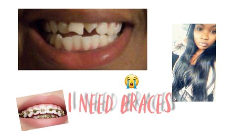 Most people associate braces with children and teens, but more and more adults get fitted for braces each year. 😭I NEED BRACES. - YouTube