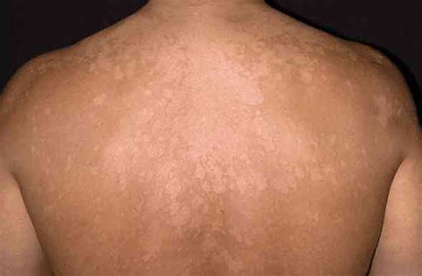 Tinea Versicolor Pityriasis Versicolor Pictures Symptoms Causes Treatment Healthmd