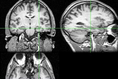 Study Autistic And Normal Brains Are Anatomically The Same