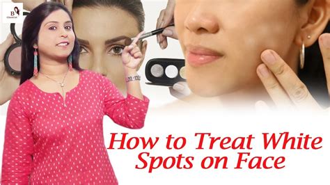 How To Treat White Spots On Face Best Home Remedies Treatment