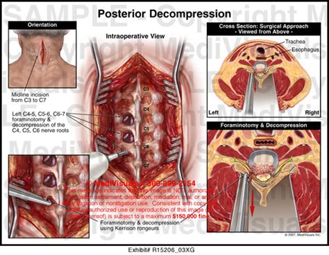 Posterior Decompression Medivisuals Medical Illustration