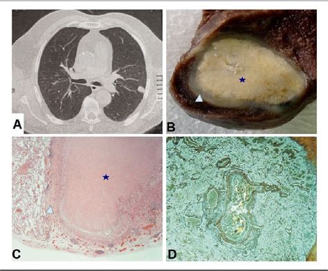 Figure 1 From An Unexpected Pulmonary Coin Lesion Semantic Scholar