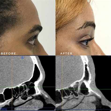 Facial Feminization Surgery Forehead Reduction Cranioplasty Type 3 Los Angeles California