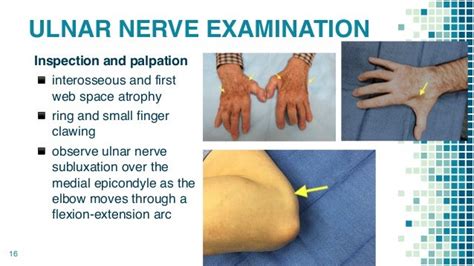 Cubital Tunnel Syndrome 1