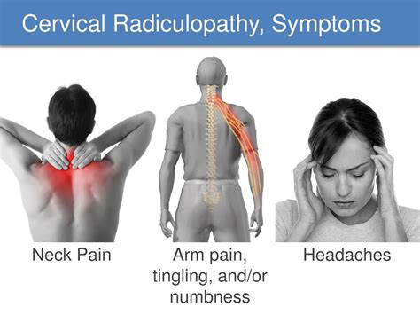 Cervical Radiculopathy Causes Symptoms Diagnosis Treatment The Best