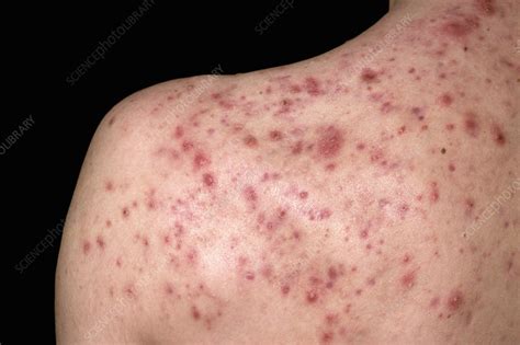 Acne Conglobata Stock Image C0384492 Science Photo Library