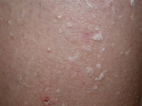 Keratoses Dorothee Padraig South West Skin Health Care