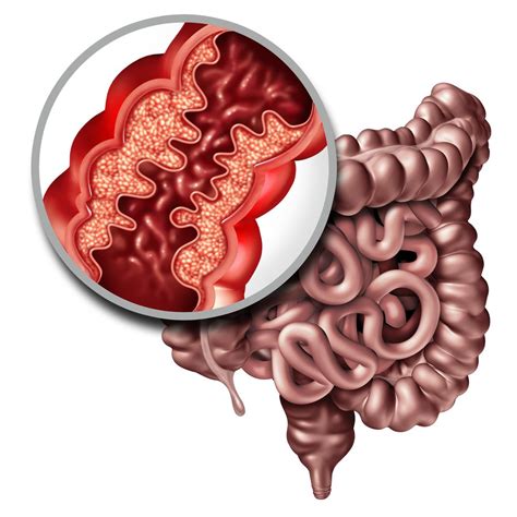 Crohns Disease Overview Causes Symptoms Treatment