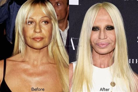 The Story Of Donatella Versace Plastic Surgery Disaster Celebrity Dr