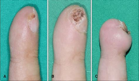 A The Initial Lesion Is A Subungual Hyperkeratotic Nodule On The