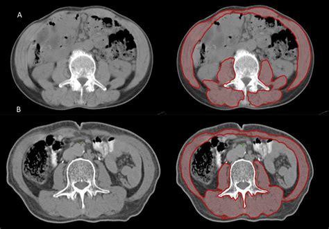 Representative Abdominal Ct Images Obtained At The Third Lumbar