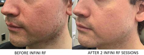 Genius Rf Microneedling Before And After Photos Patient 20 Washington