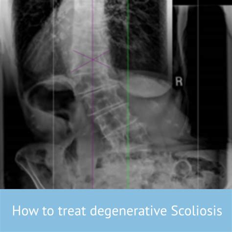 Treat Degen Scoli Scoliosis Clinic Uk Treating Scoliosis Without