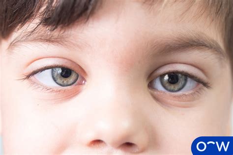 Understanding Lazy Eye Amblyopia In Children Causes Symptoms And