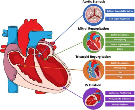 Transcatheter Heart Valve Interventions In Heart Failure Transcatheter