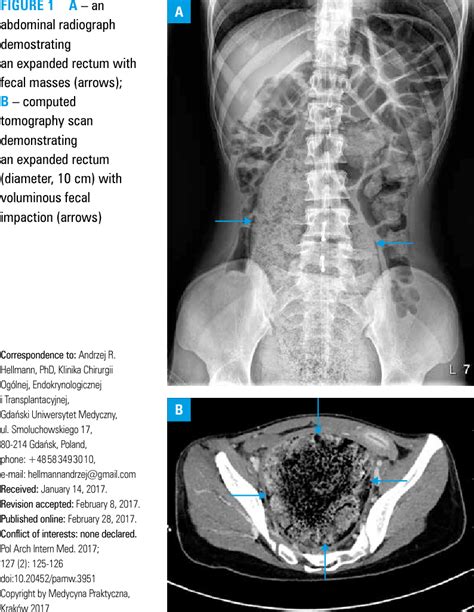 Pdf Fecal Impaction As The First Manifestation Of Addisonian Crisis