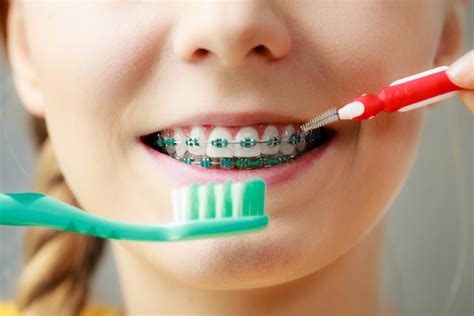 Use the same brushing motion on the inner and outer surface of all teeth. Access Dental: How to Properly Clean Your Teeth with Braces