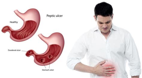 Early Symptoms Of Stomach Ulcer To Watch Out For Health Gadgetsng
