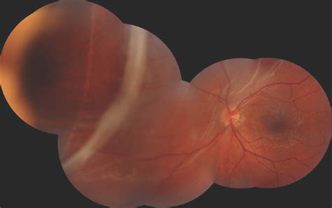 Retinal Detachment With Spontaneous Dialysis Of The Ora Serrata In A 13