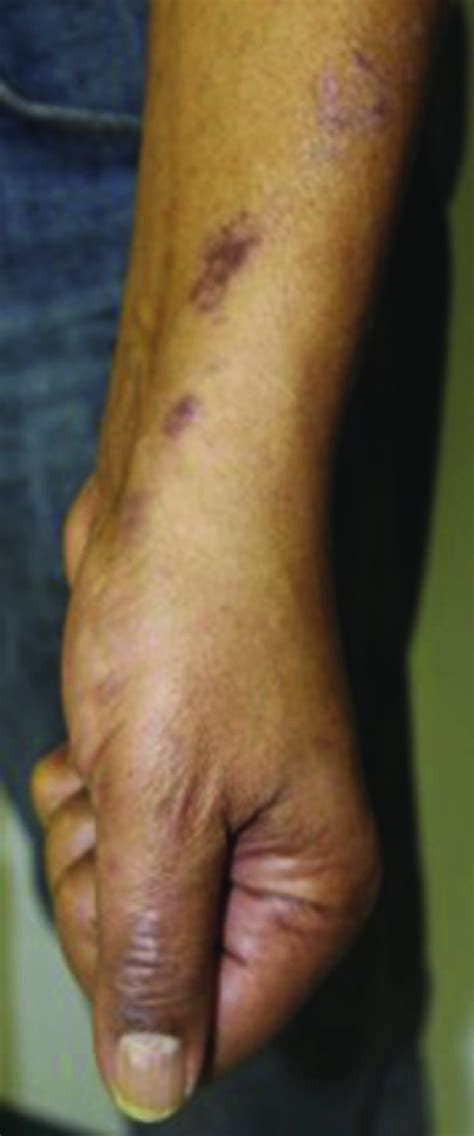 Clinical Photograph Violaceous To Erythematous Polygonal Papules And