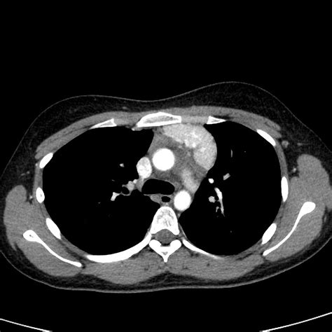 Castleman Disease Causes Symptoms Diagnosis Treatment